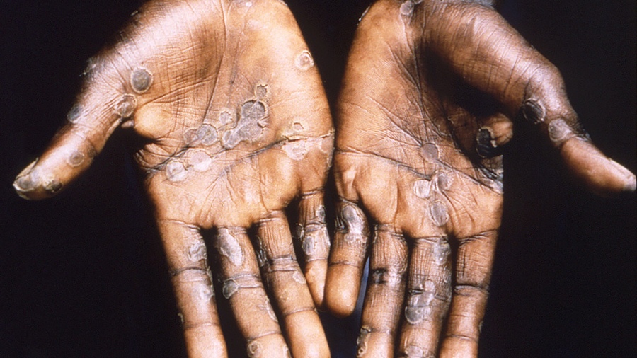 En este momento estás viendo España detectó 59 casos de viruela del mono y comprará vacunas